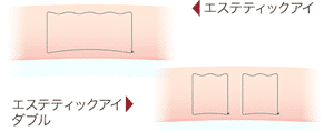 エステティックアイ埋没法糸の断面図