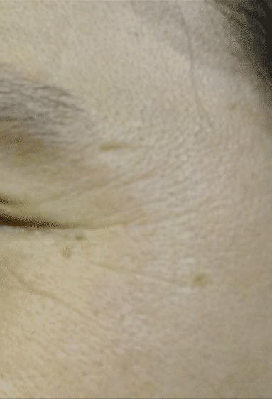 鼻尖縮小＋軟骨移植＋ストラット、鼻翼縮小（内＋外）　３ヶ月後　正面のBefore写真