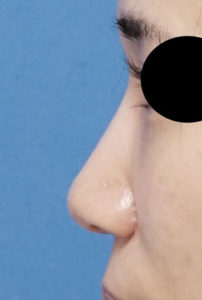 DSC07604鼻左側面