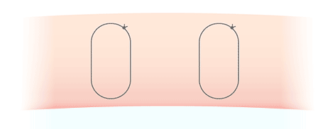 ハレにくい二重術の図