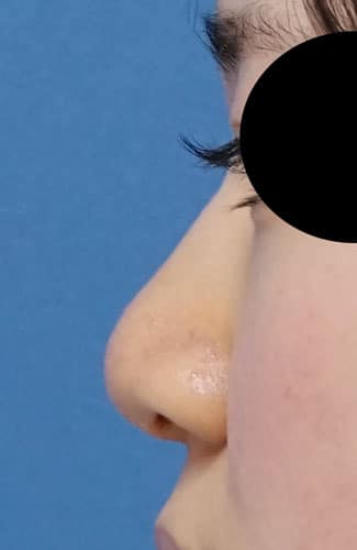 小鼻縮小（内側＋外側）、鼻尖縮小（３Ｄ法）＋軟骨移植（ストラットも）　左側面　手術前