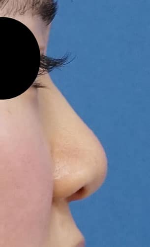 小鼻縮小（内側＋外側）、鼻尖縮小（３Ｄ法）＋軟骨移植（ストラットも）　右側面　手術前
