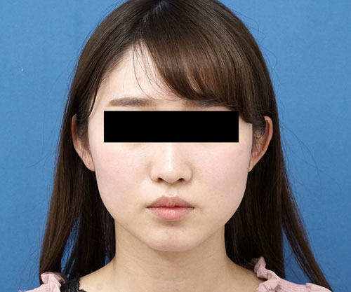 アラガン強力小顔ボトックス　1か月後のBefore写真