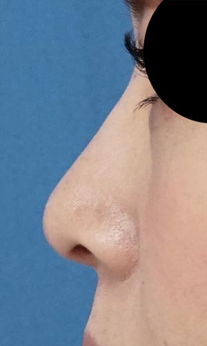 鼻尖縮小、軟骨移植　1ヶ月後のAfterの写真