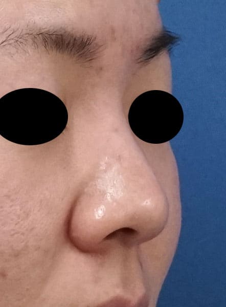 団子鼻改善（鼻尖縮小）、軟骨移植、ストラット、小鼻縮小（内側法＋外側法）　手術前　右斜め
