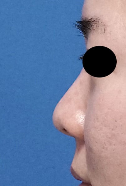 団子鼻改善（鼻尖縮小）、軟骨移植、ストラット、小鼻縮小（内側法＋外側法）　手術前　左側面