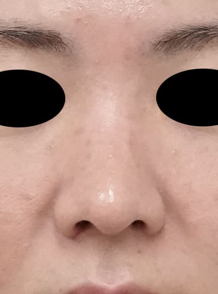 団子鼻改善（鼻尖縮小）、軟骨移植、ストラット、小鼻縮小（内側法＋外側法）　3か月後　正面