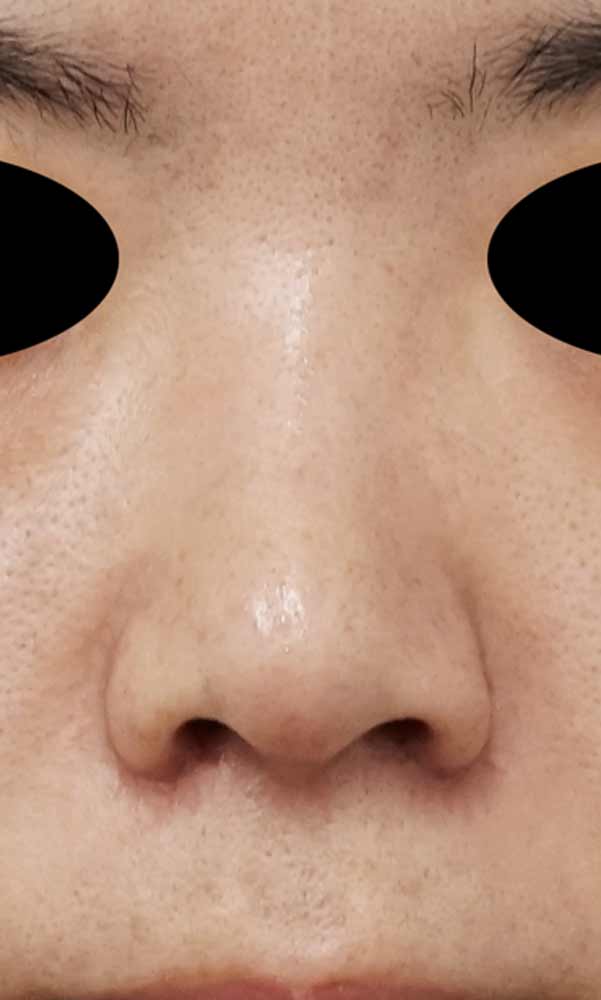 鼻翼縮小（内側法＋外側法）、鼻尖縮小、軟骨移植、ストラット　１ヶ月後のAfterの写真