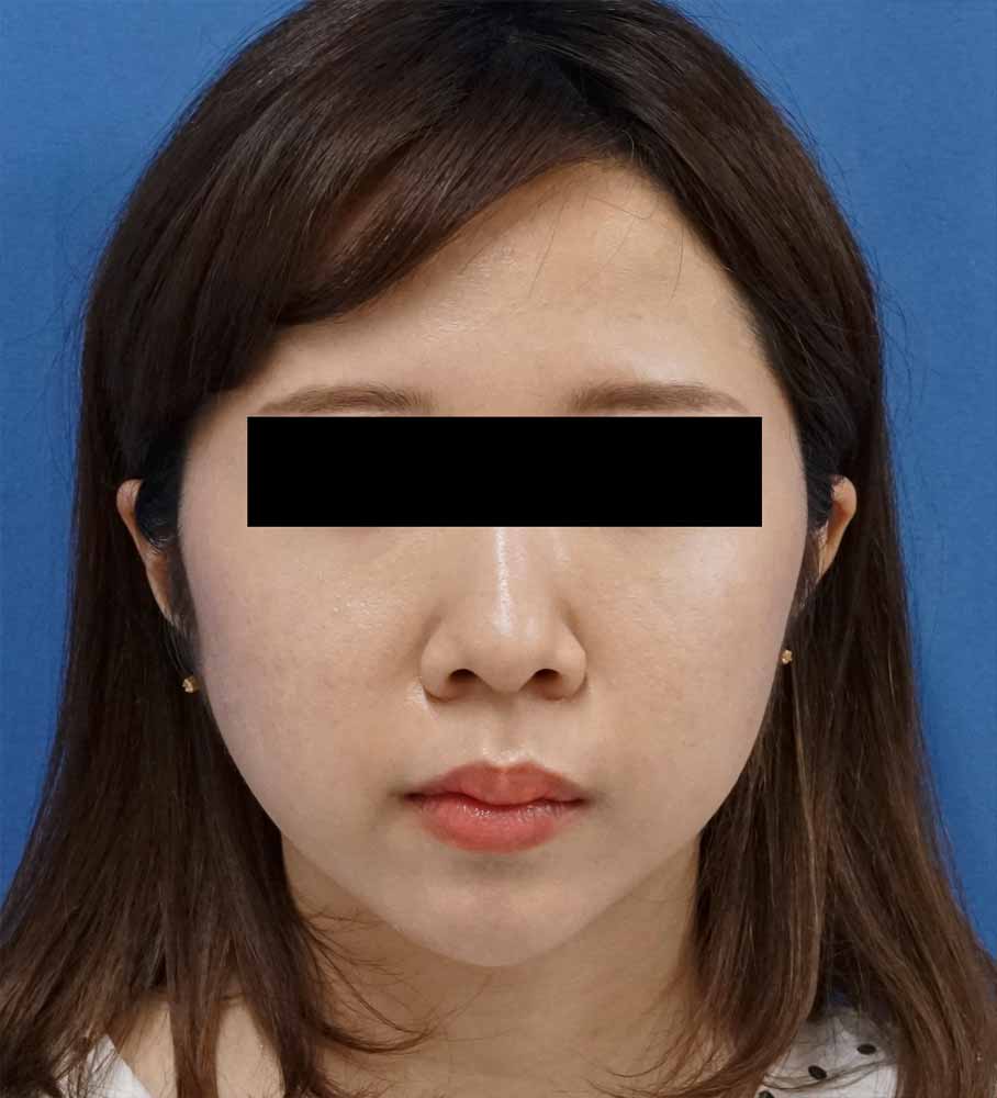 バッカルファット除去術　1ヶ月後のAfterの写真