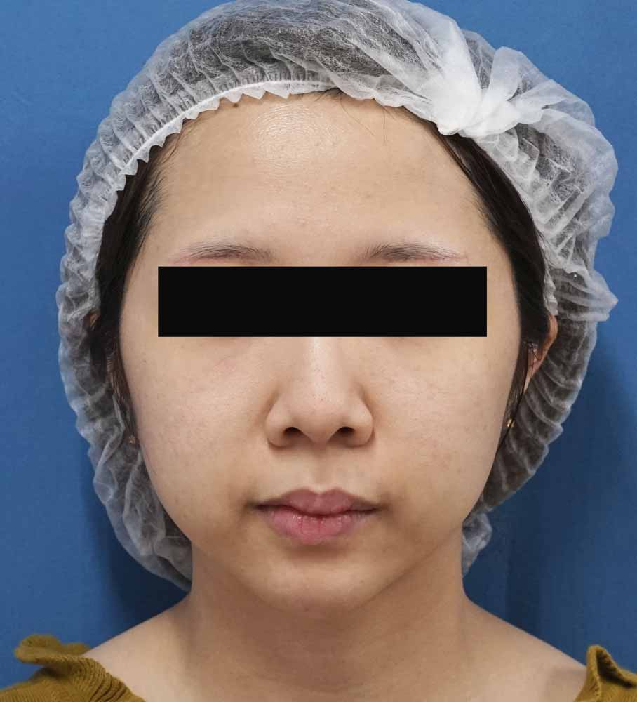 バッカルファット除去術　1ヶ月後のBefore写真