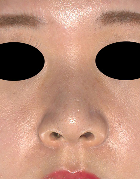 鼻尖縮小（３D法）、軟骨移植　半年後　正面のAfterの写真