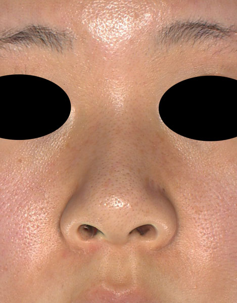 鼻尖縮小（３D法）、軟骨移植　半年後　正面のBefore写真
