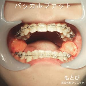 口の中のバッカルファット