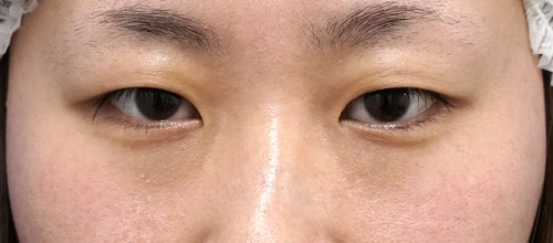 腫れにくい二重術（3点止め）3か月後のBefore写真