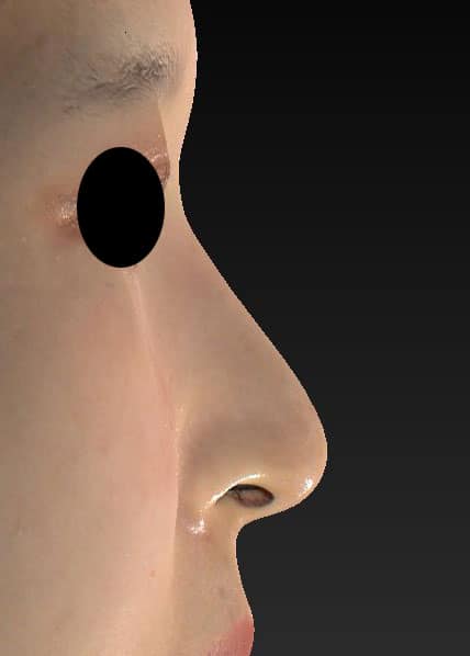 鼻尖縮小、I型プロテーゼ　3ヶ月後　右側面のAfterの写真