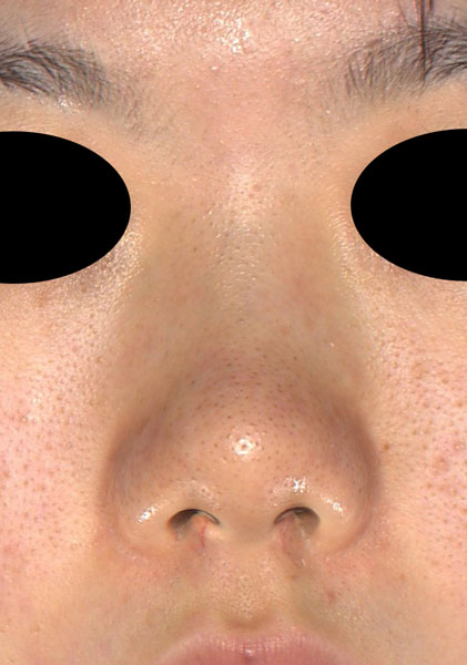鼻尖縮小、軟骨移植、Ｉ型プロテーゼ　半年後　正面のBefore写真