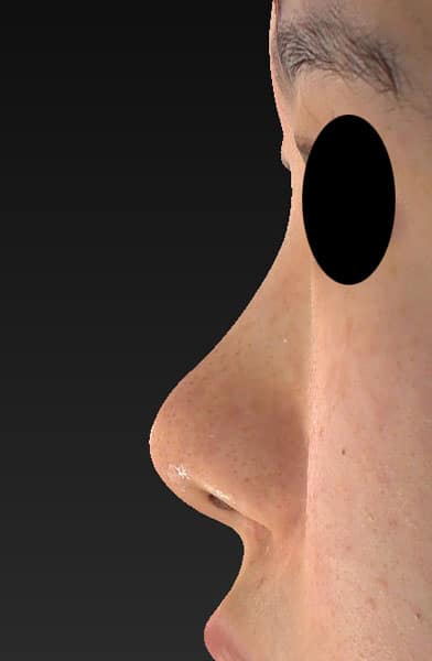 鼻尖縮小、軟骨移植、Ｉ型プロテーゼ　半年後　左側面のBefore写真