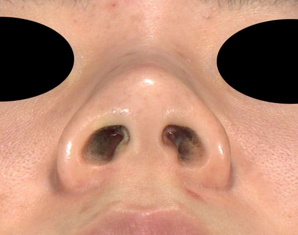 鼻尖縮小、軟骨移植、ストラット、鼻翼縮小（内側＋外側）　下から　手術前