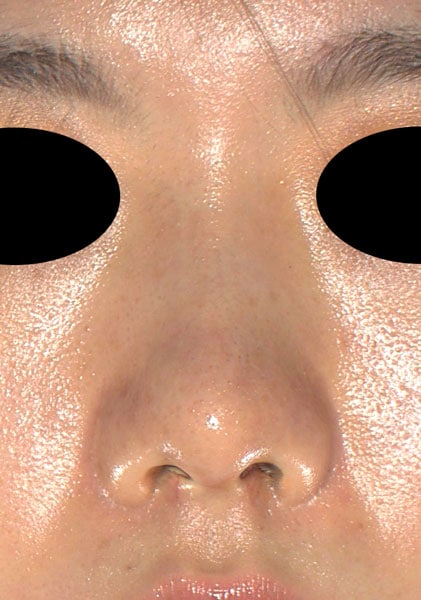鼻尖縮小、軟骨移植、Ｉ型プロテーゼ　半年後　正面のAfterの写真