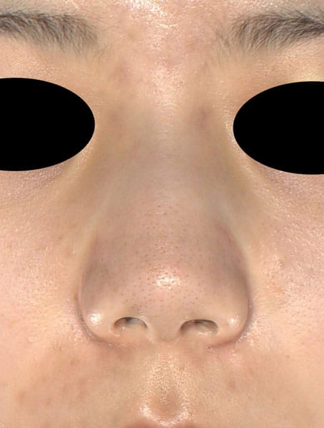 鼻尖縮小、軟骨移植　半年後　正面のBefore写真