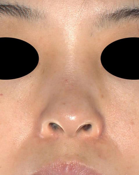 切らない鼻尖延長（ミスコ）8本、鼻クレヴィエルコントア　1週間後　正面のBefore写真