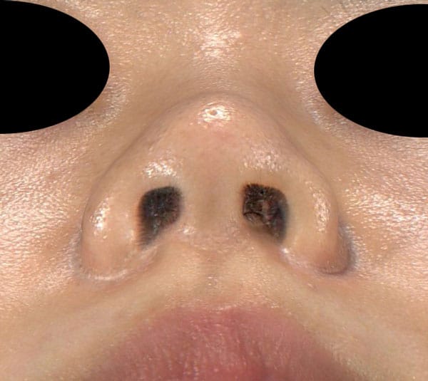 鼻尖縮小（３D法）、ストラット、軟骨移植　半年後　下から