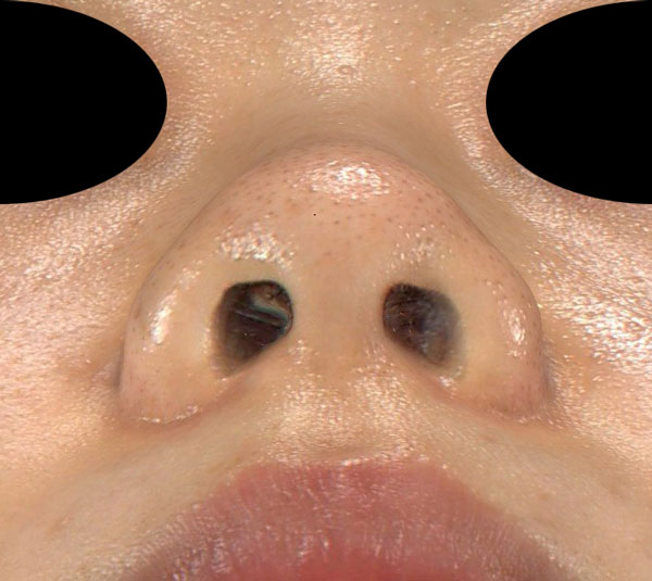 鼻尖縮小（３D法）、ストラット、軟骨移植　手術前　下から