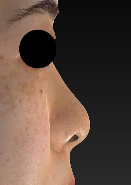 鼻尖縮小（３D法）、ストラット、軟骨移植　手術前　右側面