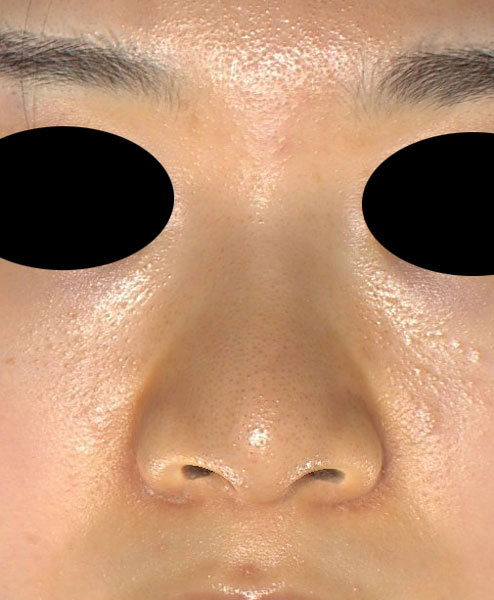 鼻尖縮小（３D法）、軟骨移植、ストラット、鼻翼縮小（内側法＋外側法）　半年後　正面のAfterの写真