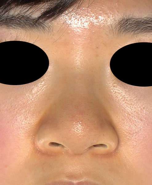 鼻尖縮小（３D法）、軟骨移植、ストラット、鼻翼縮小（内側法＋外側法）　半年後　正面のBefore写真