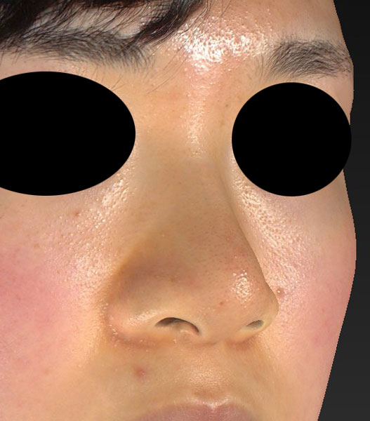 鼻尖縮小（３D法）、軟骨移植、ストラット、鼻翼縮小（内側法＋外側法）　半年後　右斜めのBefore写真