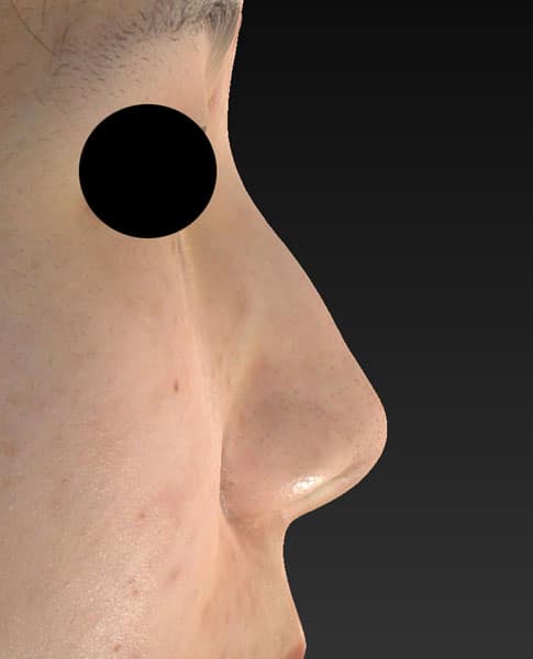 鼻尖縮小、軟骨移植　半年後　右側面のBefore写真