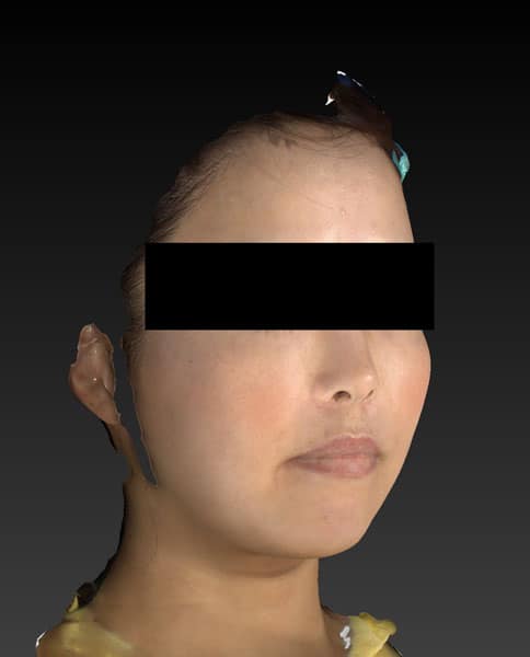 小顔脂肪吸引（ホホ・アゴ下・ほうれい線上）　半年後　右斜めのAfterの写真