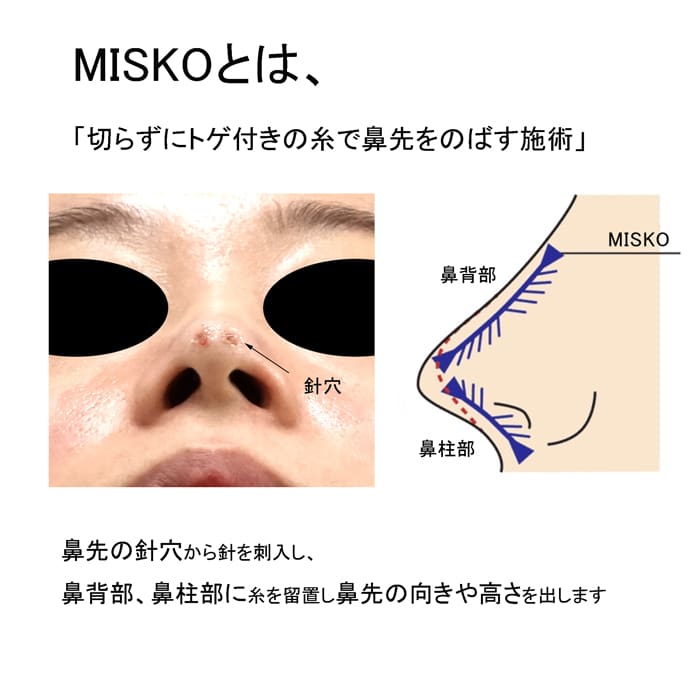 MISKO説明