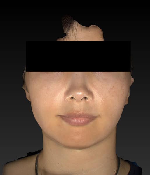 小顔脂肪吸引（ホホ・アゴ下・ほうれい線上）　4ヶ月後　正面のAfterの写真