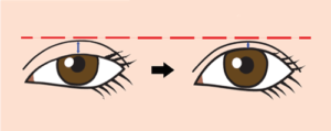 目の開きが良くなると二重が狭くなる図