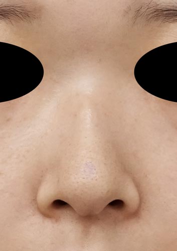 鼻尖縮小、I型プロテーゼ　3ヶ月後　正面のBefore写真