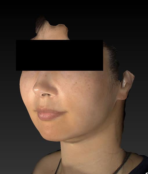小顔脂肪吸引（ホホ・アゴ下・ほうれい線上）　4ヶ月後　左斜めのAfterの写真