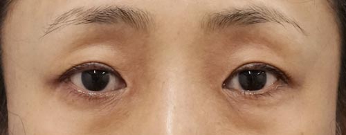 切らない眼瞼下垂　1ヶ月後のBefore写真