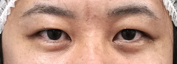 全切開、眼瞼下垂（挙筋前転術）　3ヶ月後のBefore写真