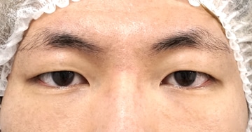 切らない眼瞼下垂プレミアム3か月後のBefore写真