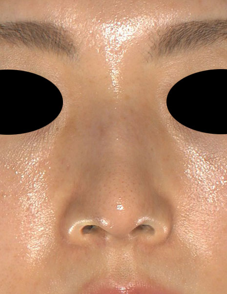 鼻尖縮小（３D法）、ストラット、軟骨移植　1ヶ月後　正面のAfterの写真