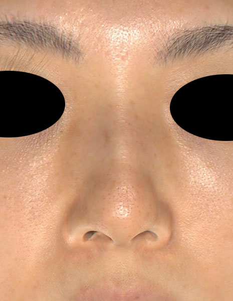 鼻尖縮小（３D法）、ストラット、軟骨移植　1ヶ月後　正面のBefore写真