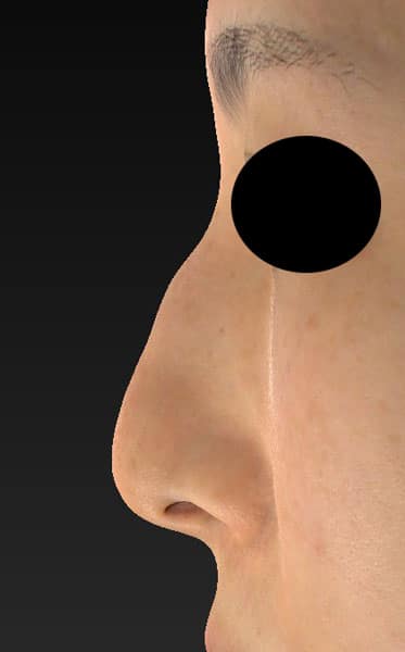 鼻尖縮小（３D法）、ストラット、軟骨移植　1ヶ月後　左側面のBefore写真