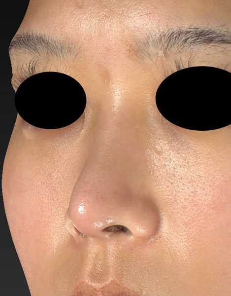 I型プロテーゼ（鼻）　3ヶ月後　のBefore写真