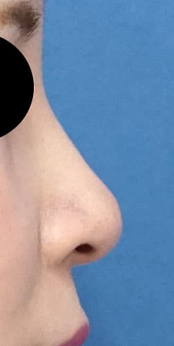 鼻孔縁延長　3ヶ月後　右側面