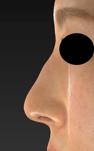 鼻尖縮小（３D法）、ストラット、軟骨移植　1ヶ月後　左側面のAfterの写真