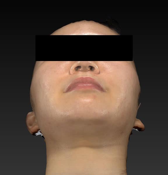 小顔脂肪吸引（ホホ・アゴ下・ほうれい線上）　3ヶ月後　下からのAfterの写真
