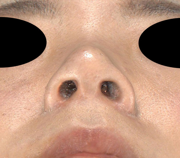 鼻尖縮小、軟骨移植、ストラット、鼻翼縮小(内側＋外側)　6ヶ月後　下からのAfterの写真