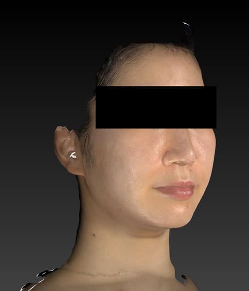 小顔脂肪吸引（ホホ・アゴ下・ほうれい線上）　3ヶ月後　右斜めのAfterの写真